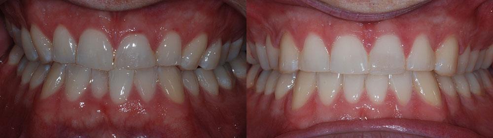 Smile before and after cosmetic orthodontics to imrpvoe appearnce after traumatic dental wear