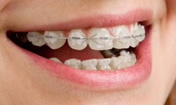 Smile with clear ceramic braces