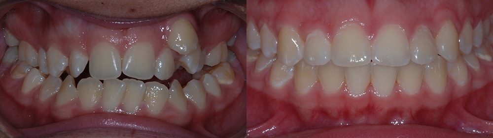 Smile before and after orthodontic treatment for crossbite and crowding