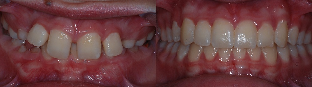 Smile before and after treatment for deepbite