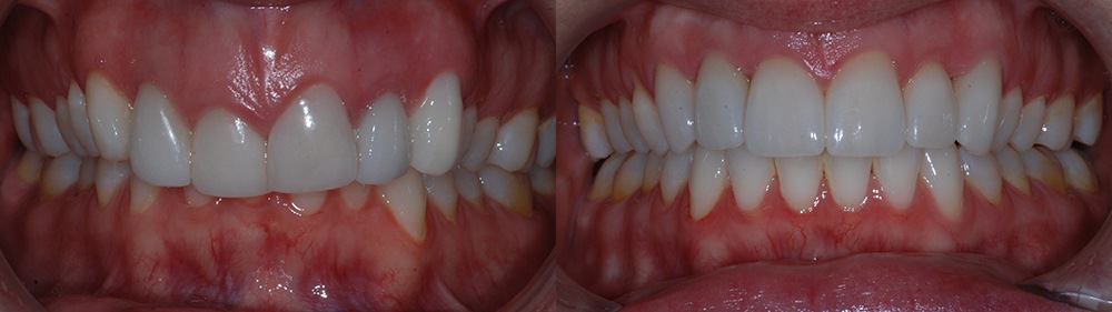 Smile before and after cosmetic orthodontic treatment to improve appearance