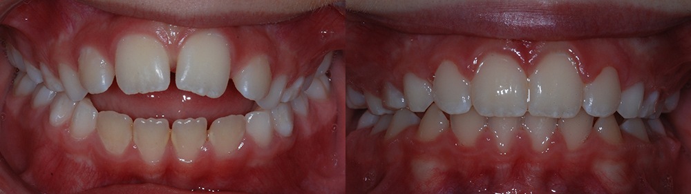 Smile before and after orthodontic treatment for openbite