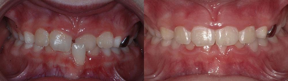 Smile before and after othodontic treatment for anteiror crossbite