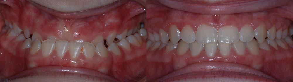 Smile before and after treatment for underbite