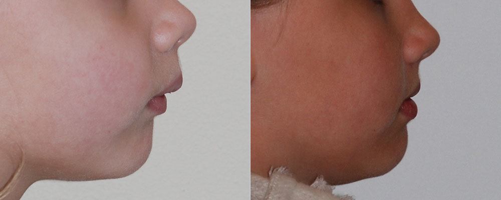 Smile before and after non-surgical jaw correction