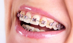 Smile with traditional metal braces