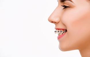 Profile of girl with significant overbite