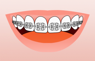 animation of teeth with braces being brushed