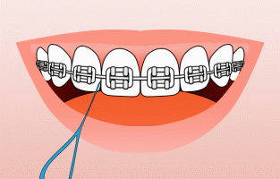 animation of teeth with braces being flossed