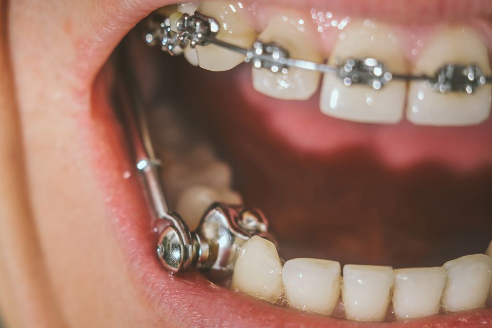 A child’s mouth with Herbst appliance